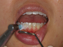 練馬区の予防歯科